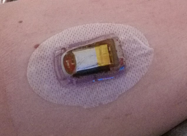 Keeping A Sensor On For Weeks – The Practical Diabetic
